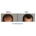 Reten Five (Minoxidil 5%) Hair Loss Treatment and Regrowth
